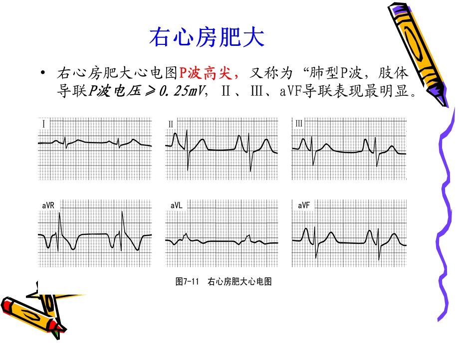 诊断学之常见异常心电图ppt课件文档资料.ppt_第3页