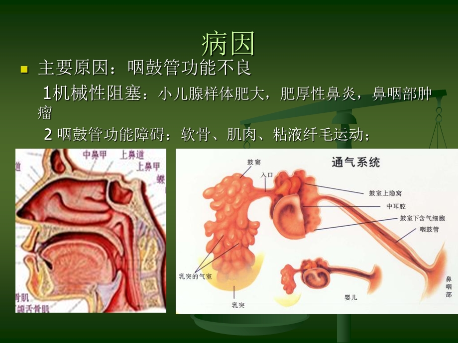 分泌性中耳炎的护理PPT文档.ppt_第3页