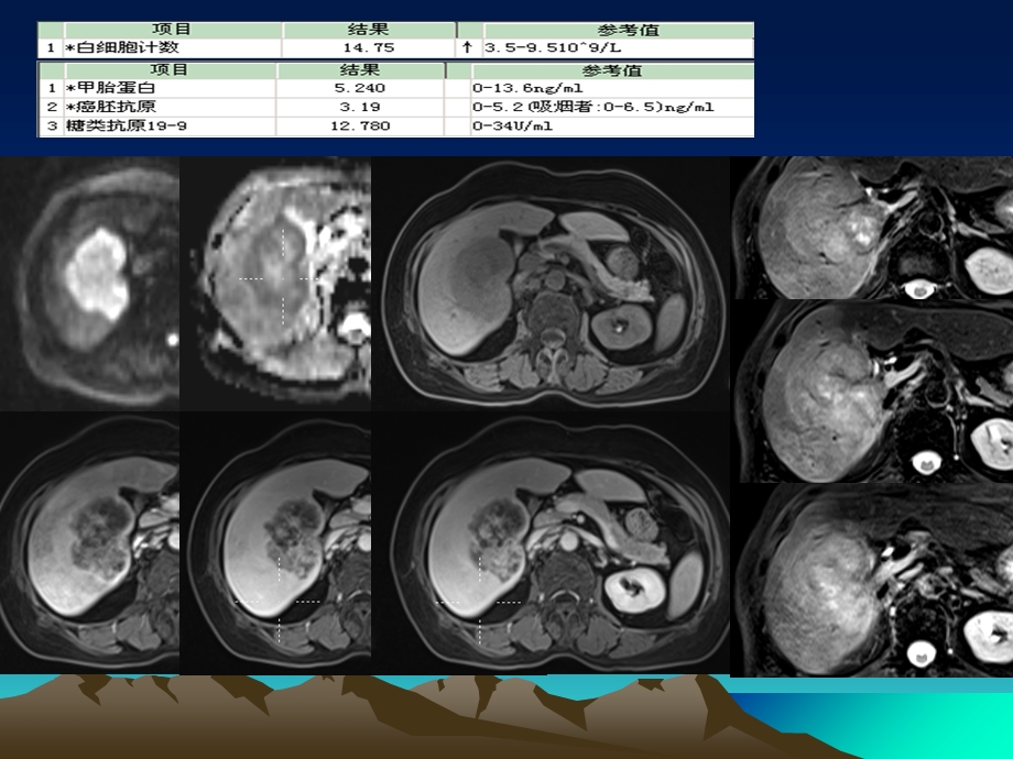 肝脏常见占位性病变及其mr鉴别ppt课件文档资料.ppt_第2页