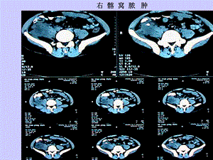 腹部CT诊断学 文档资料.ppt