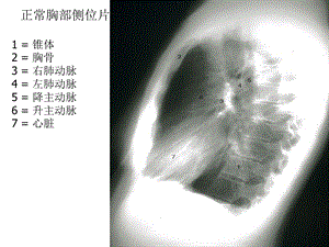 胸部X线图解胸部后前位平片图解文档资料.ppt