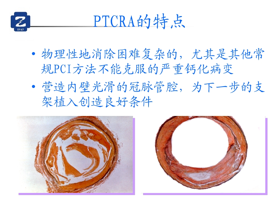 冠状动脉内旋磨联合支架术在严重钙化病变介入治疗中的应用文档资料.ppt_第2页