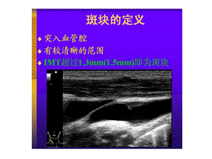 颈动脉管超声诊断文档资料.ppt