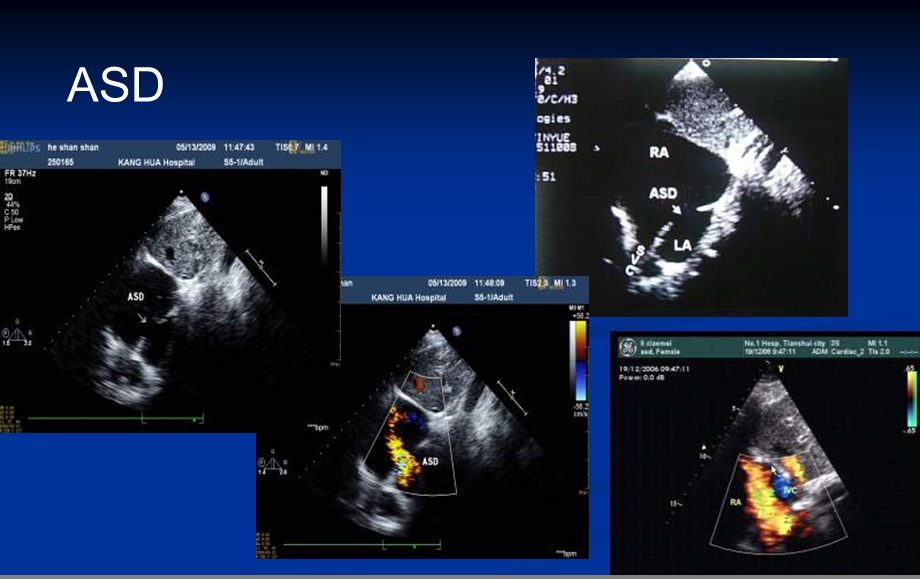 心脏超声如何满足先心病介入治疗的需要文档资料.ppt_第3页