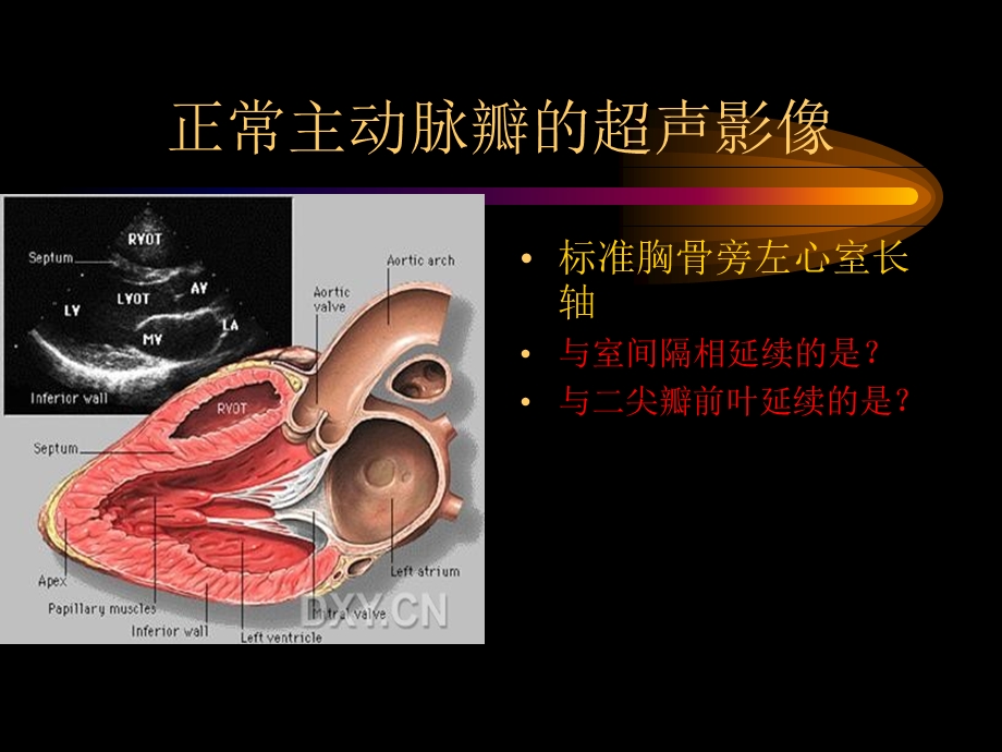 主动脉肺动脉瓣疾病ppt课件精选文档.ppt_第3页