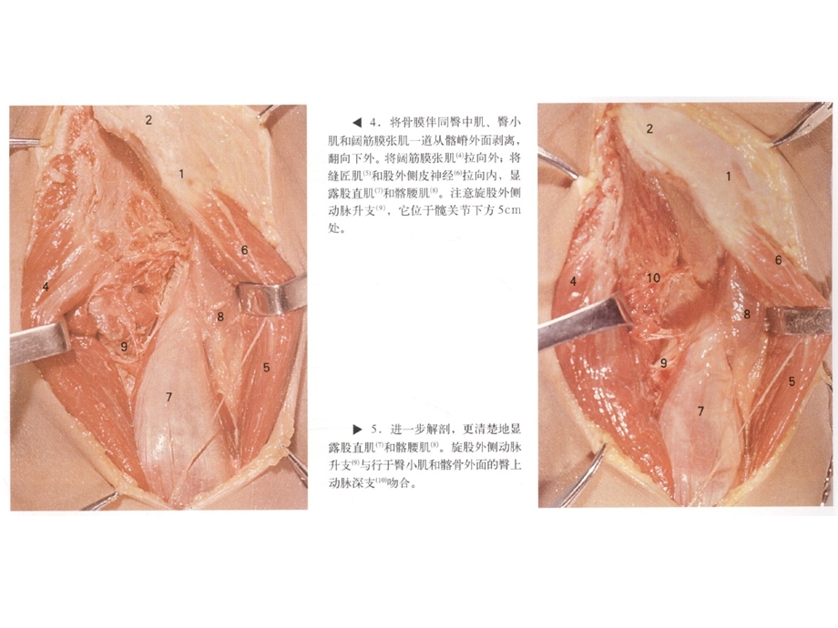 髋关节手术入路ppt课件文档资料.ppt_第3页