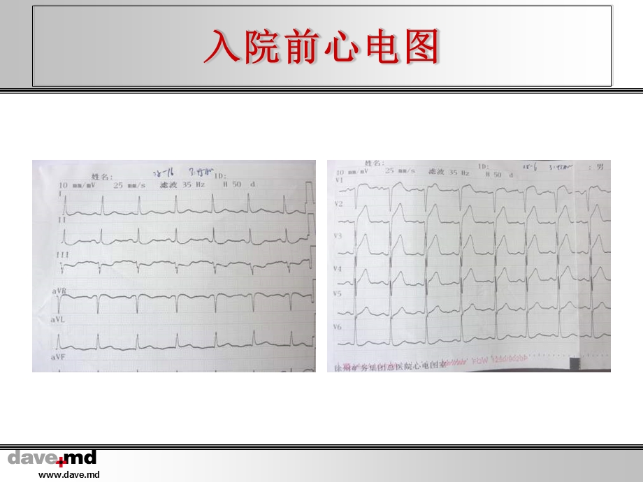 急诊PCI术中非罪犯血管闭塞例文档资料.ppt_第3页