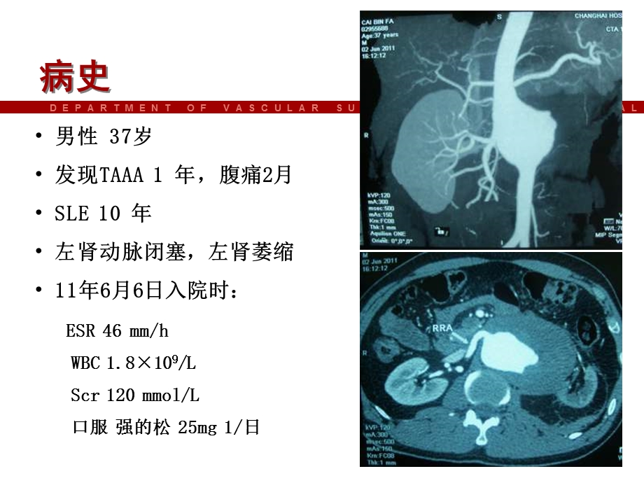 杂交手术治疗活动期炎Ⅳ型胸腹主动脉瘤教学课件文档资料.ppt_第1页