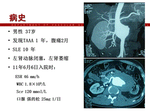 杂交手术治疗活动期炎Ⅳ型胸腹主动脉瘤教学课件文档资料.ppt