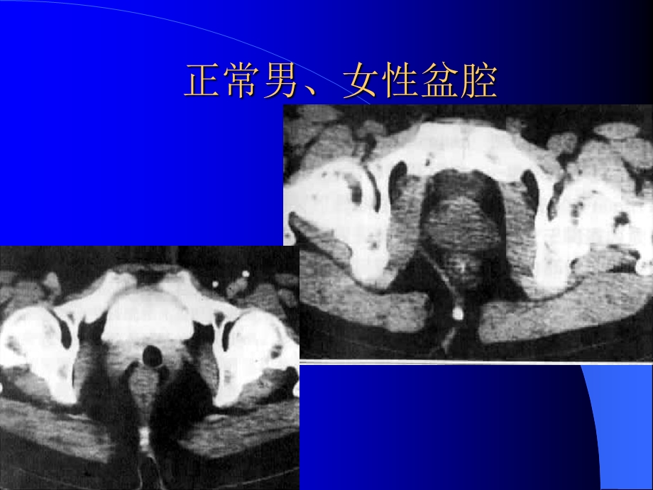 腹腔及腹膜后CT诊断2ppt课件文档资料.ppt_第1页