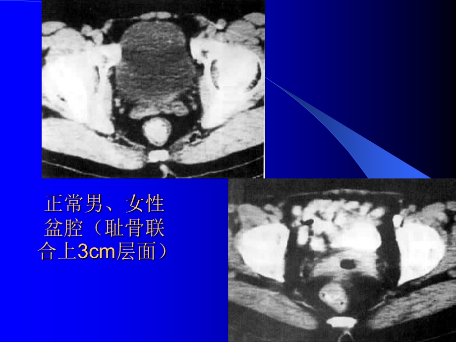 腹腔及腹膜后CT诊断2ppt课件文档资料.ppt_第2页