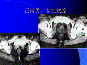 腹腔及腹膜后CT诊断2ppt课件文档资料.ppt