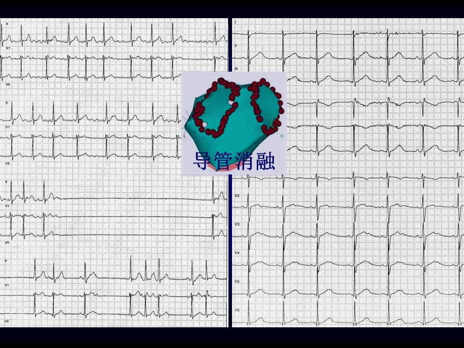 导管消融对心电图的影响文档资料.ppt_第1页