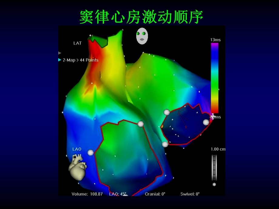 导管消融对心电图的影响文档资料.ppt_第2页