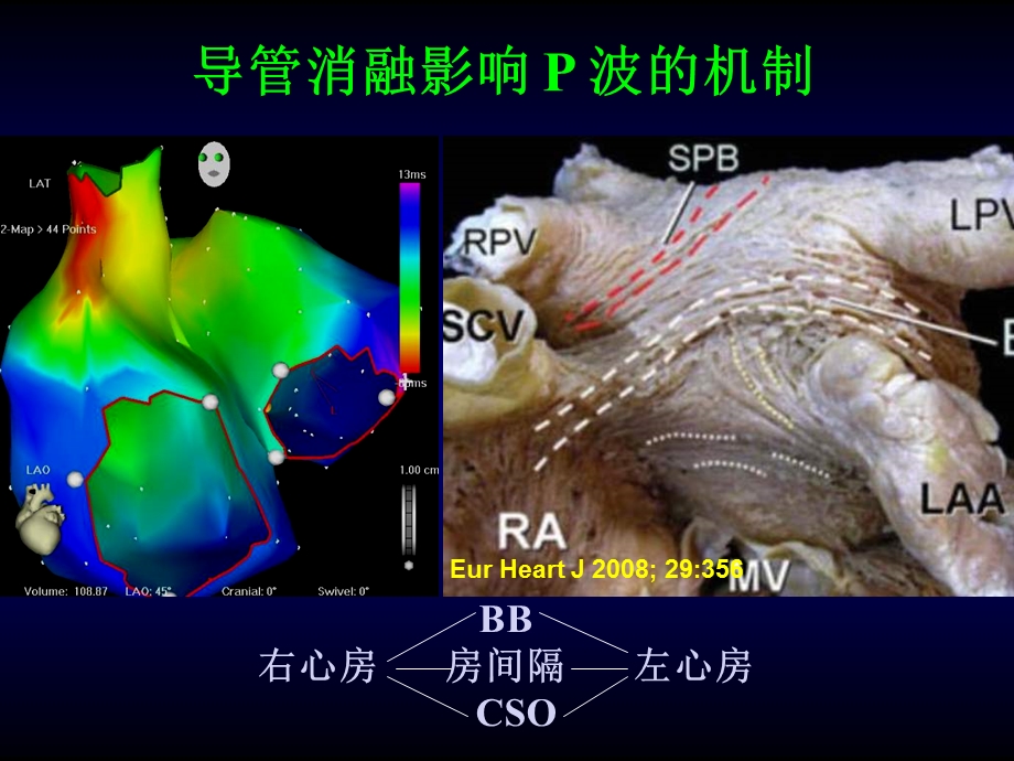 导管消融对心电图的影响文档资料.ppt_第3页