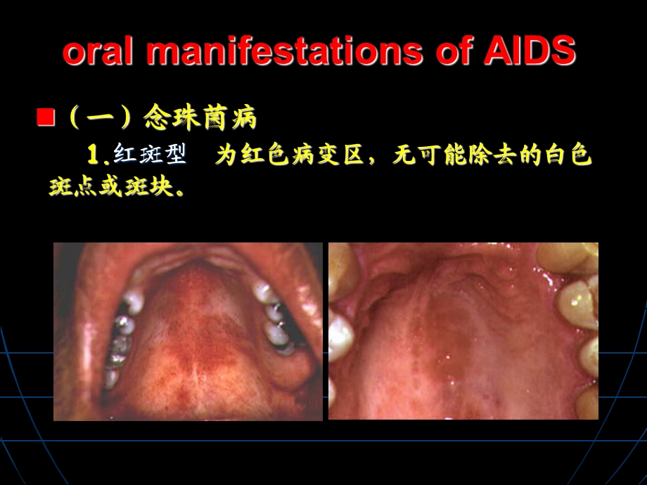 艾滋病口腔表征文档资料.ppt_第3页