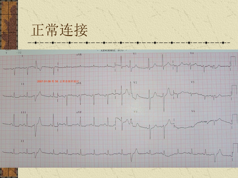 心电图正常值文档资料.ppt_第1页