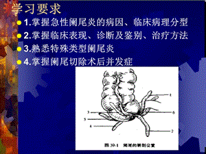 临床医学概要34阑尾炎溃疡穿孔精选文档.ppt