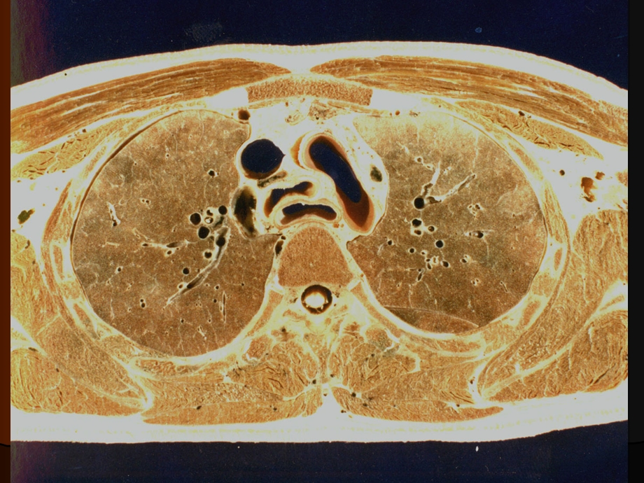 胸部ct实用断层解剖ppt课件文档资料.ppt_第3页