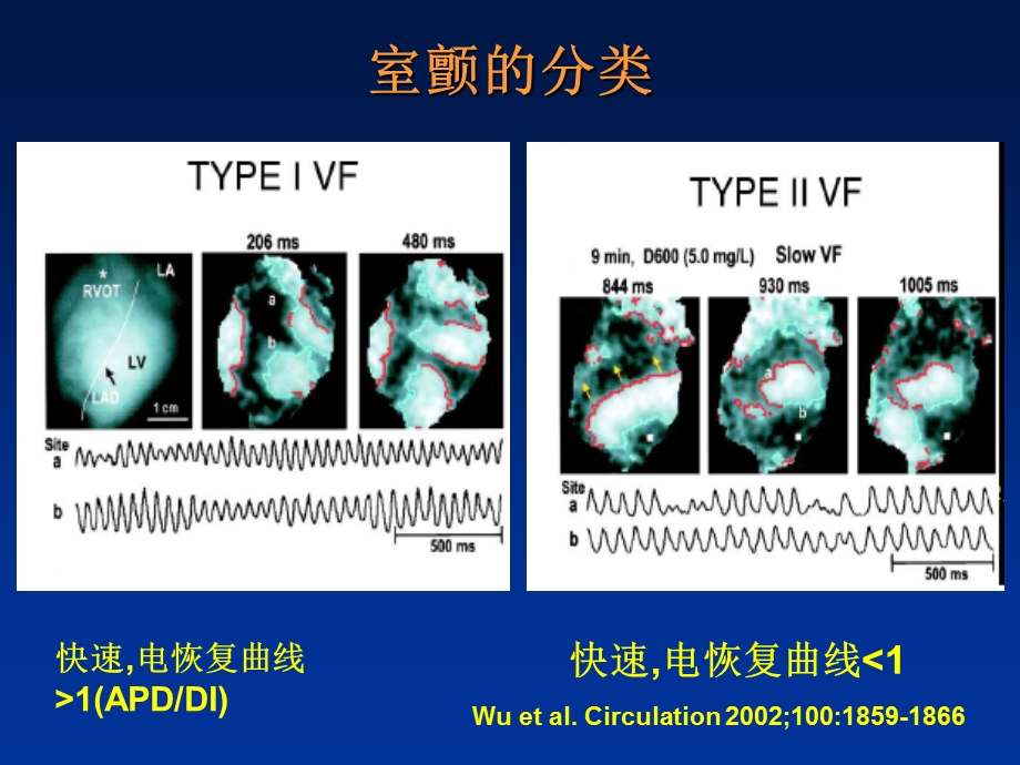 心室颤动和多形性室速消融触发灶吴书林文档资料.ppt_第2页