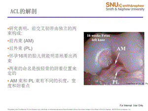 解剖型ACL重建文档资料.ppt