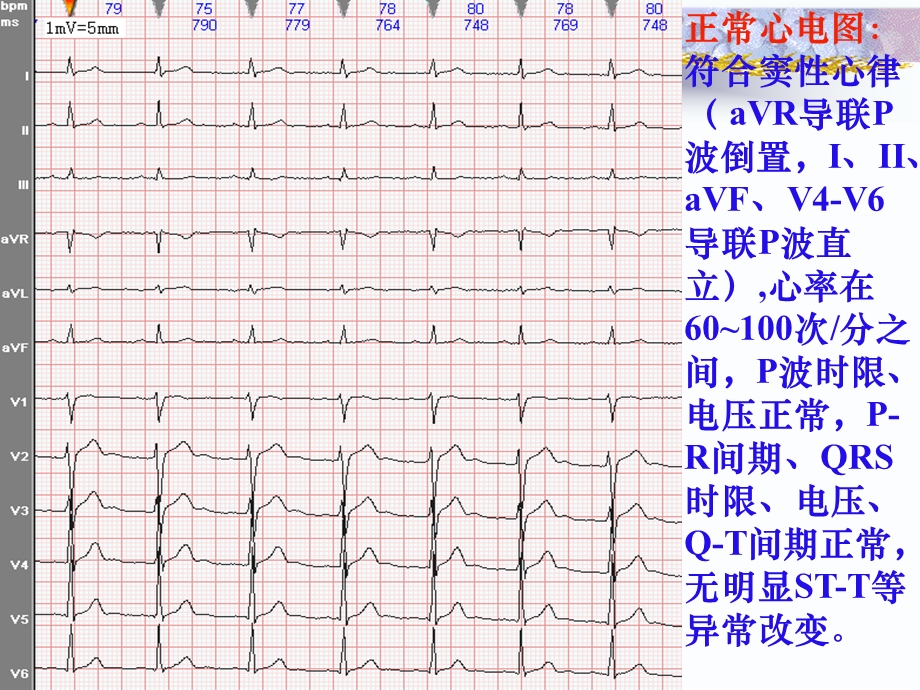 常见心电图诊断实习生教案之二文档资料.ppt_第3页