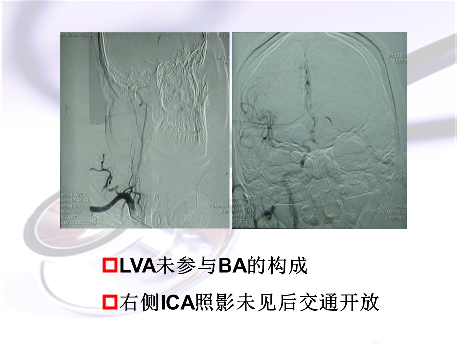 脑血管夹层的治疗文档资料.ppt_第3页