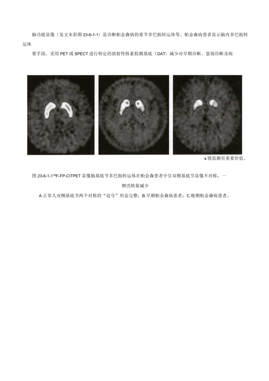 少动-强直综合征（帕金森）诊疗规范2023版.docx_第3页