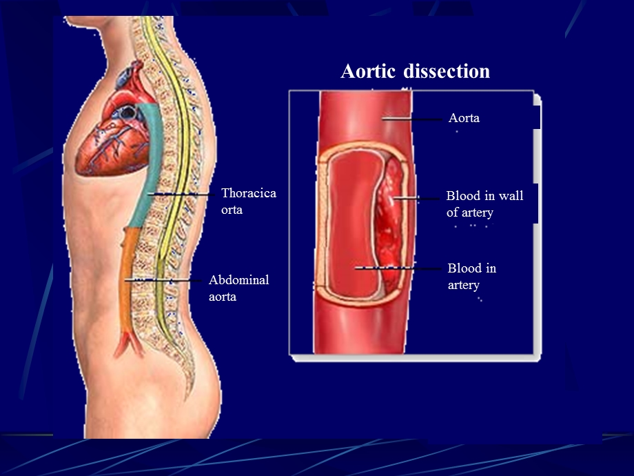 主动脉夹层本科生大课ppt课件文档资料.ppt_第3页