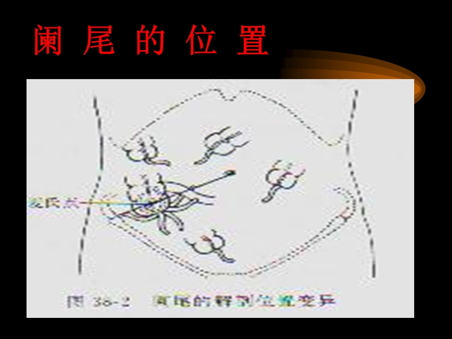 13阑尾炎、腹部教学幻灯PPT课件.ppt_第2页