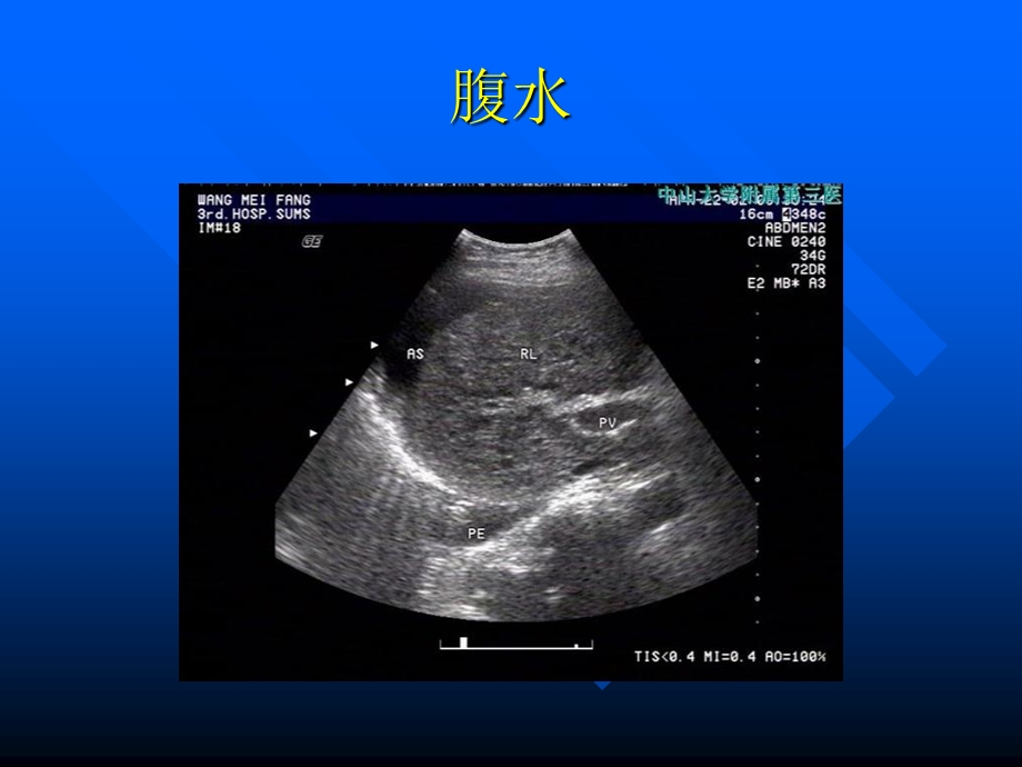 介入、腹膜后超声诊断文档资料.ppt_第2页