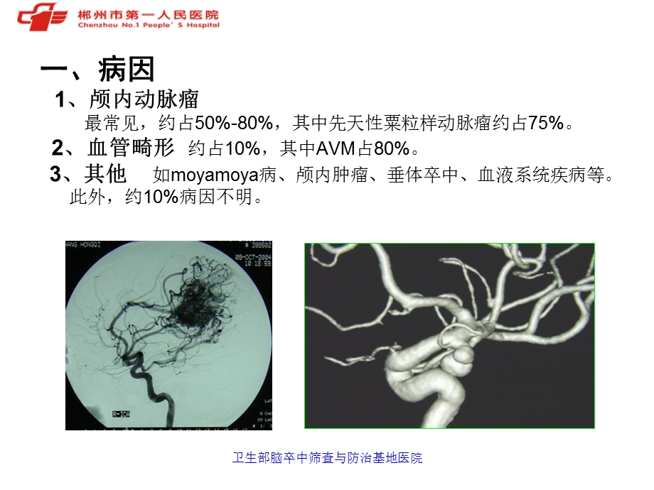 动脉瘤性蛛网膜下腔出血诊治PPT文档.ppt_第3页