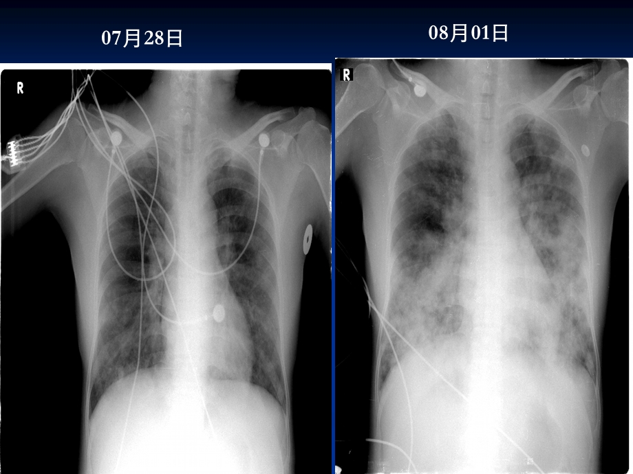 侵袭性肺部真菌感染患者的护理ppt课件文档资料.ppt_第1页