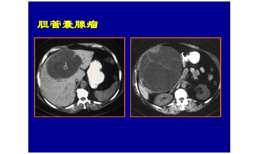 肝脏囊性占位灶ppt课件文档资料.pptx_第2页