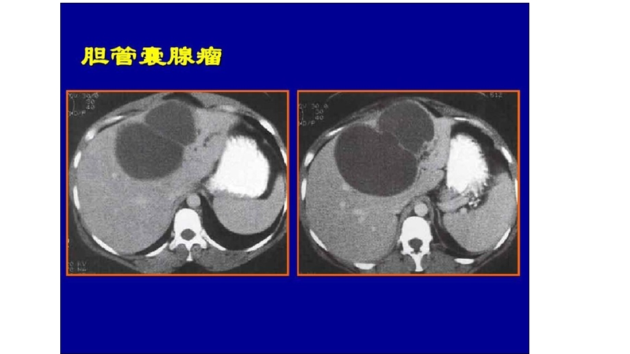 肝脏囊性占位灶ppt课件文档资料.pptx_第3页