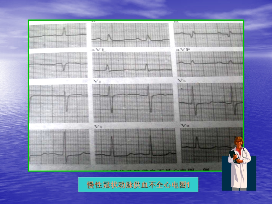 心肌供血与心电图PPT文档.ppt_第3页