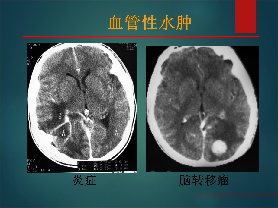 中枢神经系统疾病影像表现ppt课件文档资料.ppt_第3页