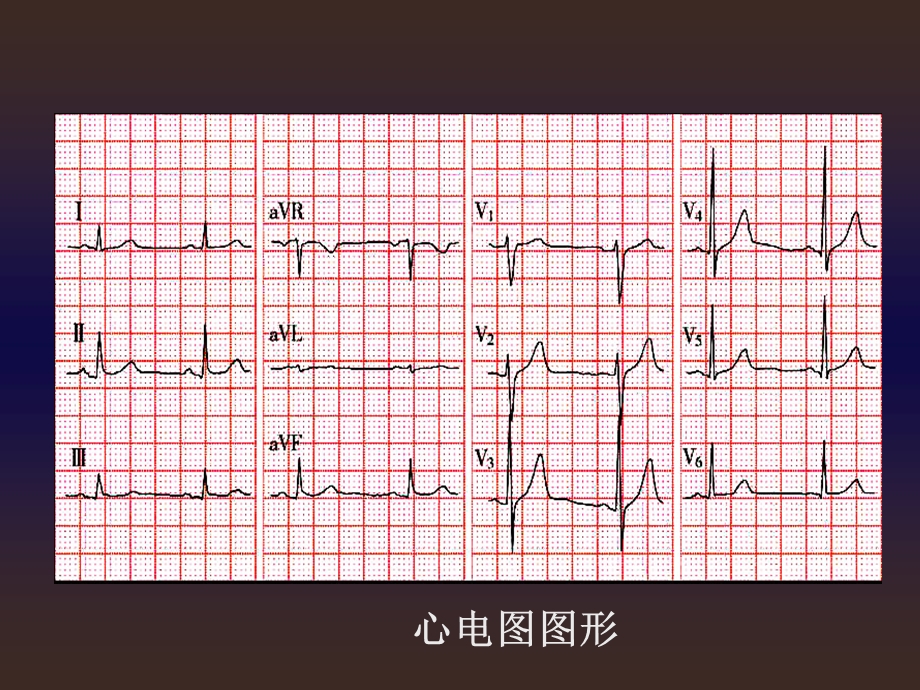 本心电图ppt课件文档资料.ppt_第3页