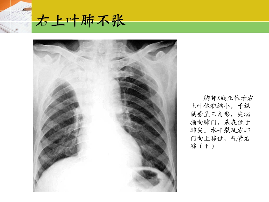 常见疾病x片精选文档.ppt_第1页