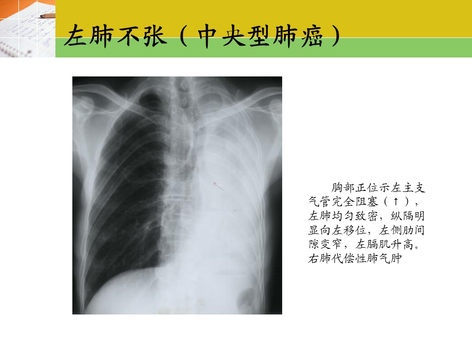 常见疾病x片精选文档.ppt_第3页