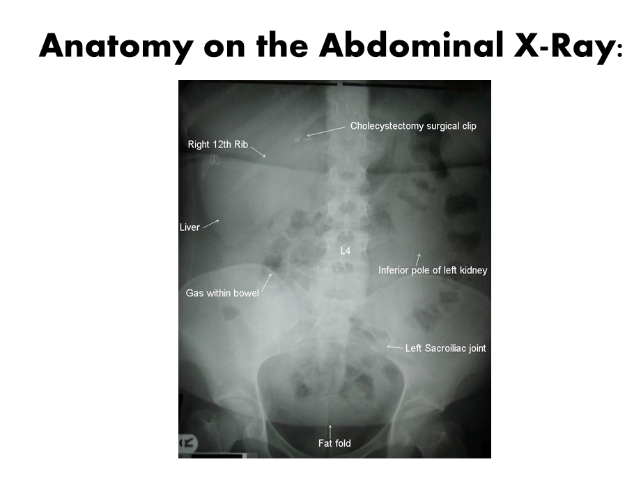 The Abdominal XRayNajran University Portal ：腹部X线纳季兰大学门户精选文档.ppt_第3页