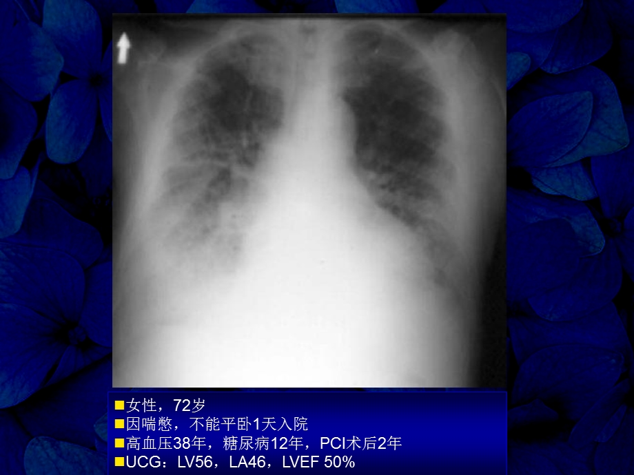 0412射血分数正常心力衰竭的诊断和治疗进展康连鸣PPT课件.ppt_第1页