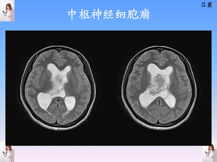 医影在线CNS疾病影像图库文档资料.ppt_第2页