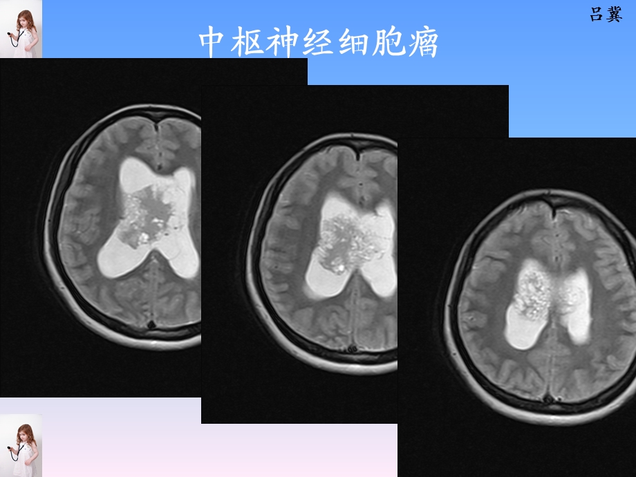 医影在线CNS疾病影像图库文档资料.ppt_第3页