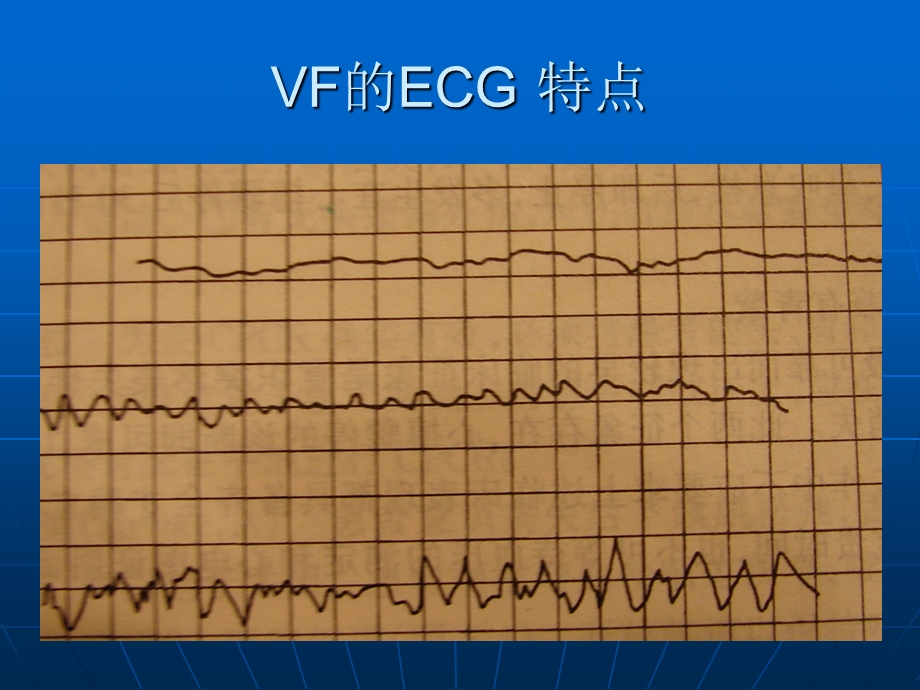 心肺复脑复苏文档资料.ppt_第3页