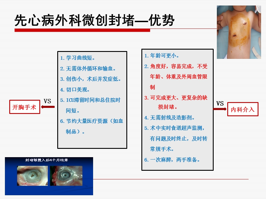 外科微创封堵治疗先心病的陷阱和应对策略修改版本ppt课件PPT文档.pptx_第3页