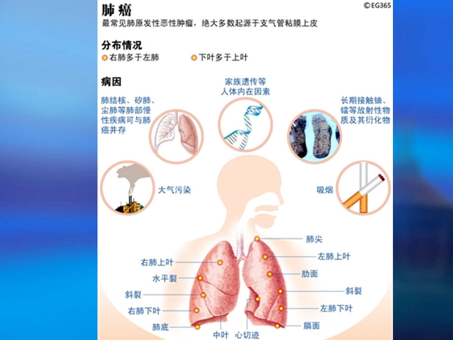 支气管肺癌的护理PPT文档.ppt_第3页