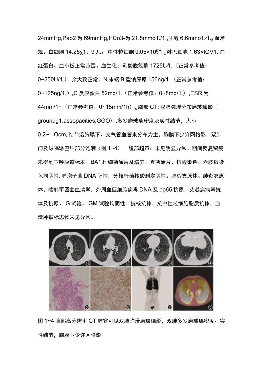 最新：双肺弥漫磨玻璃影伴多发结节.docx_第2页