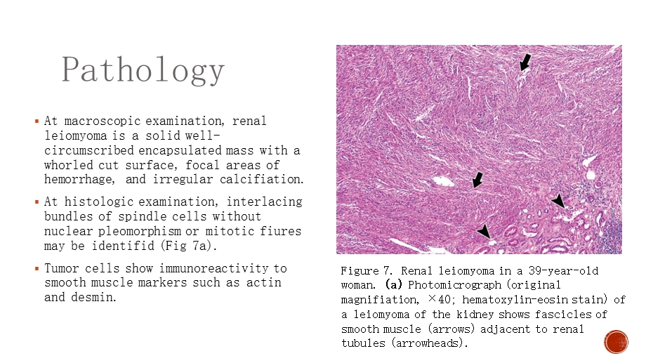 最新肾平滑肌瘤PPT文档.ppt_第2页