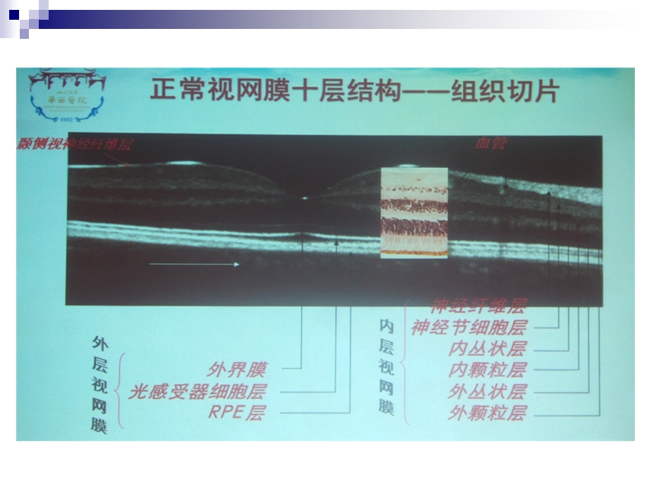 最新黄斑疾病简版ppt课件PPT文档.ppt_第3页